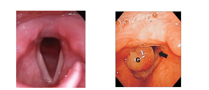 granulomas